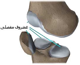 پارگي غضروف زانو