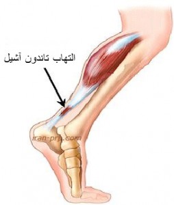 تاندونیت آشیل